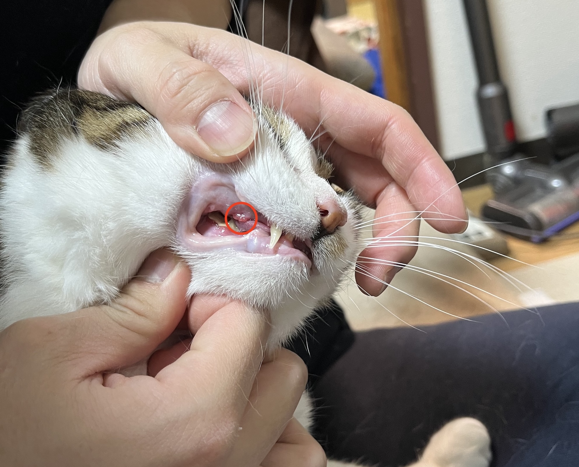 赤い丸の部分が抜けた さらに奥の歯は2年前に抜歯済み